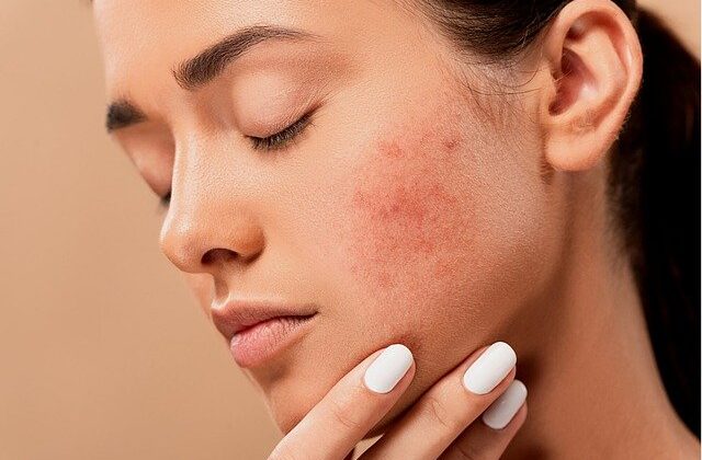 What is the best treatment for acne?