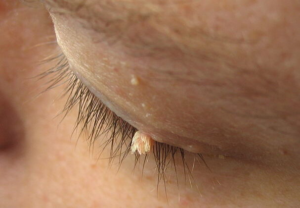 get rid of Warts