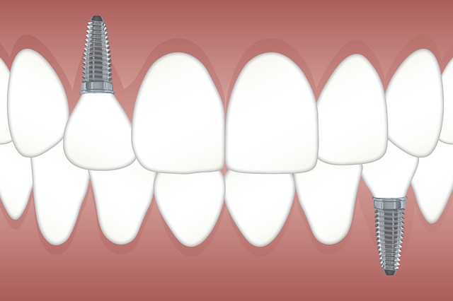 Different Types of Dental Implants