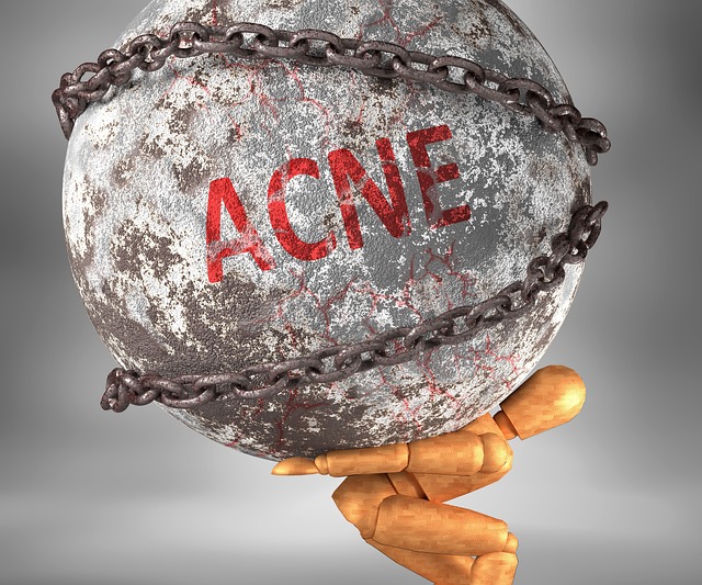 Body Acne – Tips and Knowledge You Need to Know About Causes and Treatment