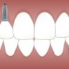 Are All On 4 Dental Implants Only For The Wealthy